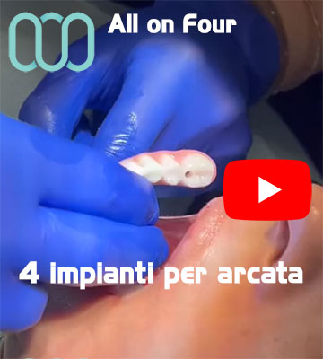 all-on-four-4-impianti-dentali-per-arcata-Albania-Tirana