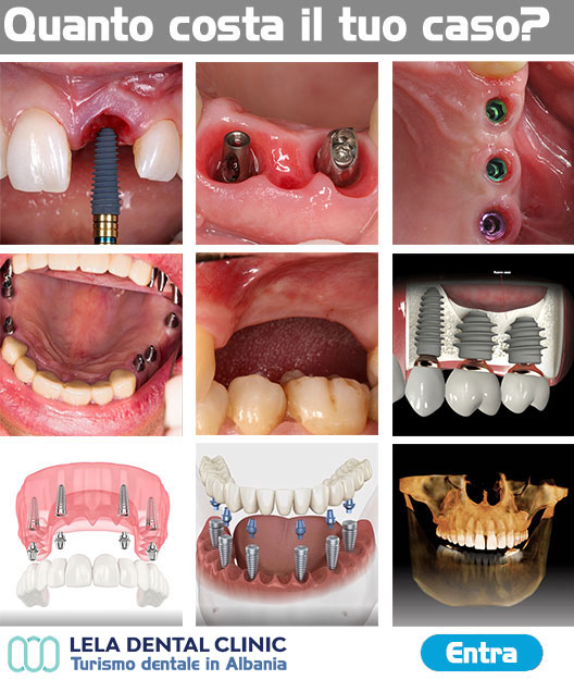 quanto-costano-gli-impianti-dentali-in-Albania-a-Tirana