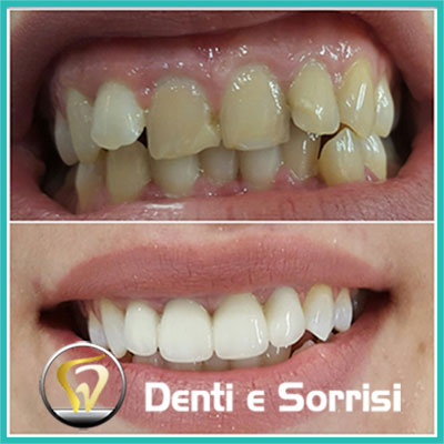 denti-e-sorrisi-turismo-dentale-in-albania-a-tirana-33