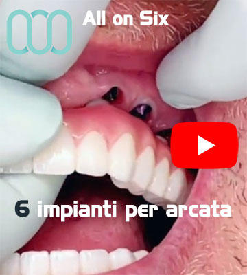 all-on-six-6-impianti-dentali-per-arcata-Albania-Tirana